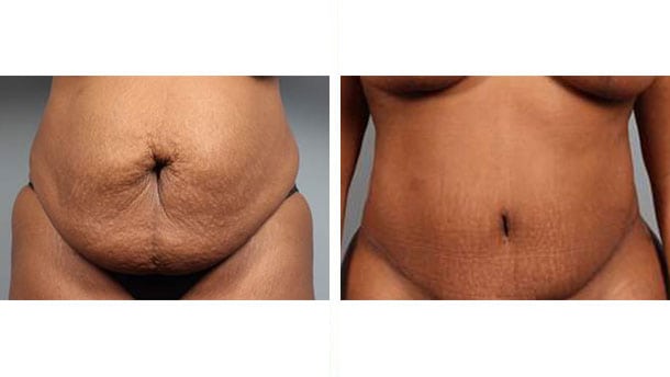 Before and After Image: Tummy Tuck with Liposuction - front