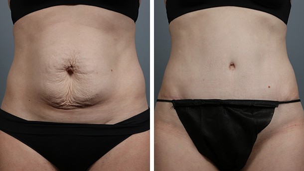 Before and After Image: Tummy Tuck with Liposuction - front