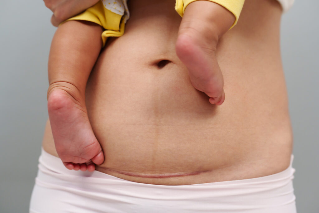 Close up of a new mom's lower belly with stretch marks and a extra skin after getting a c-section. Close up of a new mom's lower belly with stretch marks and a extra skin after getting a c-section.